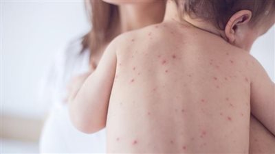 جدري الماء.. فيروس يهدد الأطفال والحوامل 