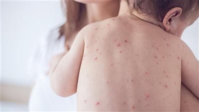 هيئة الدواء تكشف الفرق بين الحزام الناري وجدري الماء