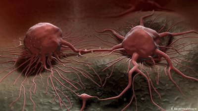 الورم بيقضي على نفسه.. تكنولوجيا جديدة لعلاج السرطان دون تدخل كيميائي أو إشعاعي