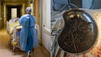 وسط دهشة الأطباء.. العثور على مسامير وصواميل تزن أكثر من كيلو في معدة مريض