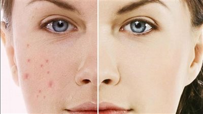 تخلص من حب الشباب، بالأعشاب الطبيعية أبرزها النيم والريحان