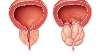 طبيب أورام يحذر: أي رجل تخطى الـ 50 عاما معرض للإصابة بسرطان البروستاتا خاصة هؤلاء