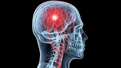 احذر، هذه الأطعمة قد تتسبب بالسكتة الدماغية