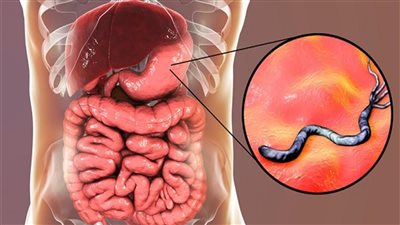 قد تسبب السرطان.. أهم أعراض جرثومة المعدة وطرق الوقاية