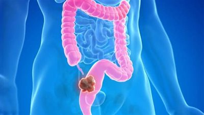 أعراض سرطان القولون، يجب استشارة الطبيب عند ظهور هذه العلامات