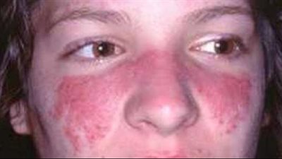 التأثيرات النفسية لمرض الذئبة الحمراء، وما هي أعراضه وأسبابه؟