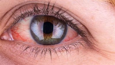 ماذا تعرف عن مرض متلازمة تشارلز ميلر