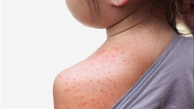 هذه طرق الوقاية، أشهر الأمراض الجلدية في فصل الصيف (فيديو)