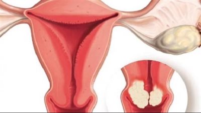  أعراض سرطان الرحم المبكرة، أبرزها اضطراب الدورة الشهرية والنزيف الحاد