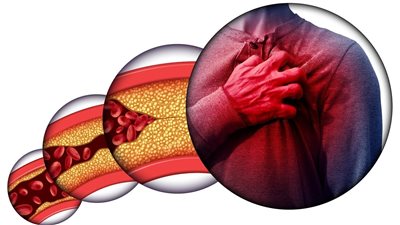 قد تؤدي للوفاة، مخاطر زيادة الدهون الثلاثية في الجسم