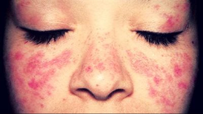 أعراض الذئبة الحمراء المبكرة، الاهتمام بالعلاج يمنع مضاعفاتها الخطيرة 