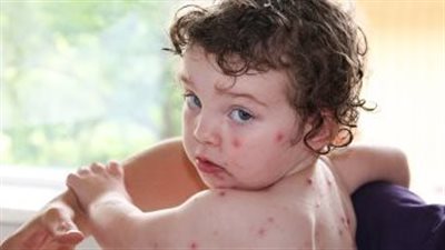 أسباب الجدري، وأعراضه وطرق العلاج والوقاية 