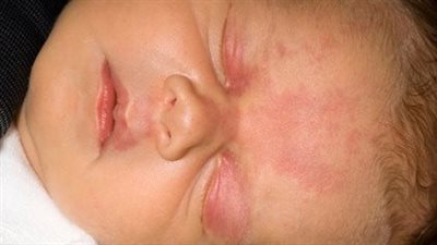 ما هي قبلة الملائكة التي تصيب حديثي الولادة وما مدى خطورتها؟