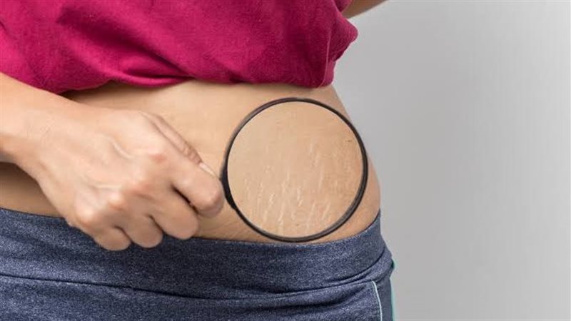 تمدد الجلد وعلاجه،