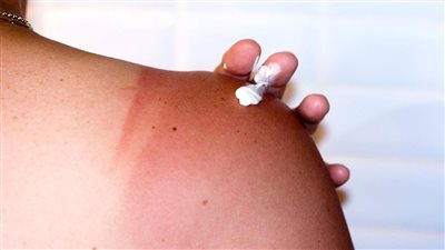 الصحة تحذر من الإصابة بأورام الجلد بسبب أشعة الشمس 