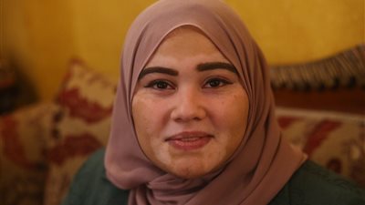 حكاية نهى مع البهاق، بين التنمر ومراحل العلاج (فيديو)