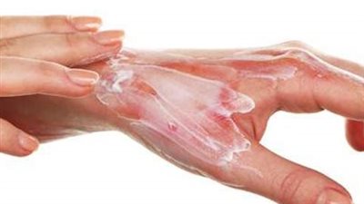 هيئة الدواء تقدم 6 نصائح للإسعافات الأولية لعلاج الحروق