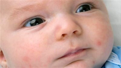 أفضل علاج لحمو النيل للأطفال، في أسرع وقت