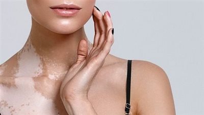 طرق التخلص من بقع البهاق وأعراضه 