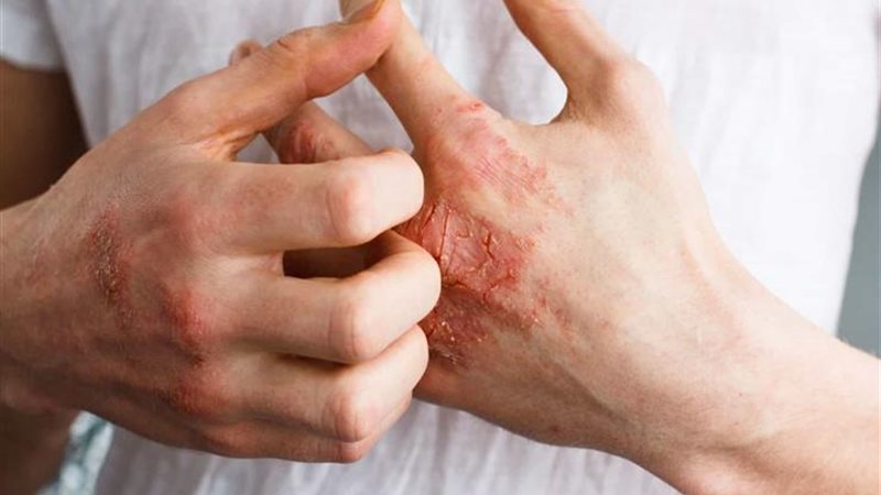 مقاومة الأنسولين،