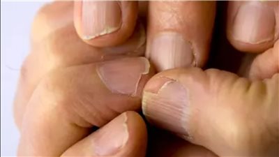 احذر من تقصف الأظافر، مؤشر لهذه الأمراض 