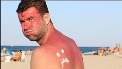 الصحة: حروق الشمس تحدث فقط لأصحاب هذه البشرة