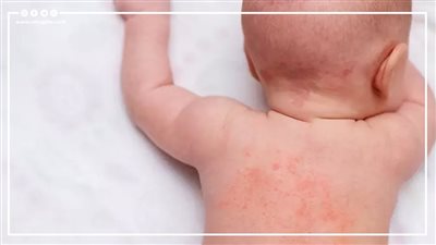 تجنب الإصابة وطرق الوقاية، حمو النيل يهدد صحة الأطفال والكبار مع اشتداد حرارة الصيف