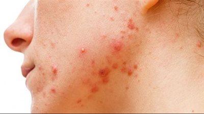 علاج حب الشباب بسرعة في المنزل بمكونات من مطبخك