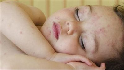 أبرزها حمو النيل، مخاطر الطقس الحار على الطفل الرضيع 