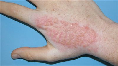 علاج لسعات قنديل البحر، الصحة تنصح بالذهاب للمستشفى في هذه الحالة 