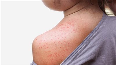 أفضل علاج لحمو النيل، الاستحمام والملابس القطنية