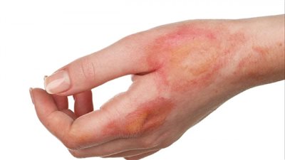 قرح الفراش مرض جلدي يصيب كبار السن، ونصائح مهمة للوقاية منه (فيديو) 