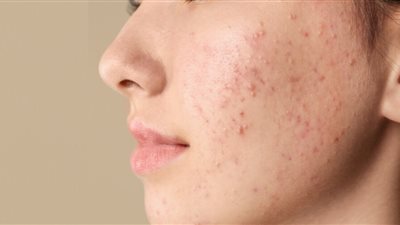أستاذ بالقومي للبحوث يكشف أحدث علاج للتخلص من حب الشباب نهائيا
