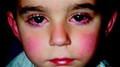 مرض كاواساكي، الأسباب والأعراض وطرق العلاج