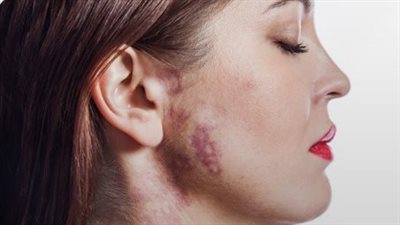 الوحمات الدموية، تظهر في سن الـ 40 عاما وهذه أبرز طرق العلاج (فيديو) 