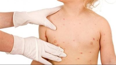 أعراض الجديري المائي، وطرق التعامل الصحيح مع الطفل لحين شفائه