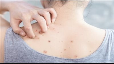 علاج انحلال البشرة الفقاعي، وكيفية التخفيف من الأعراض