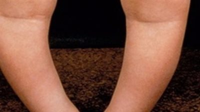  أسباب تقوس الساقين عند الأطفال وطرق العلاج