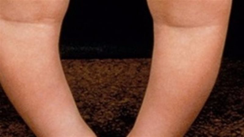 أسباب تقوس الساقين،