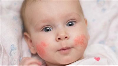 حساسية الطعام عند الأطفال، أهم الأعراض و8 أطعمة يجب الحذر منها 