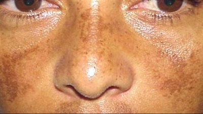 قناع منعش للبشرة بعد يوم طويل في الشمس