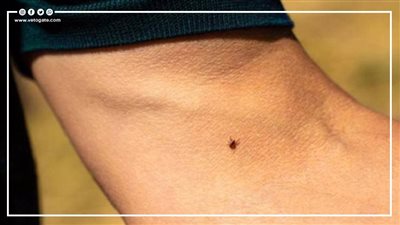 ألونجشان.. فيروس جديد ينتشر في أوروبا بسبب القراد (فيديوجراف)