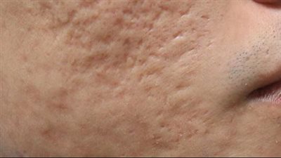 قناع طبيعي يخفى حفر الوجه ويقلل المسام الواسعة