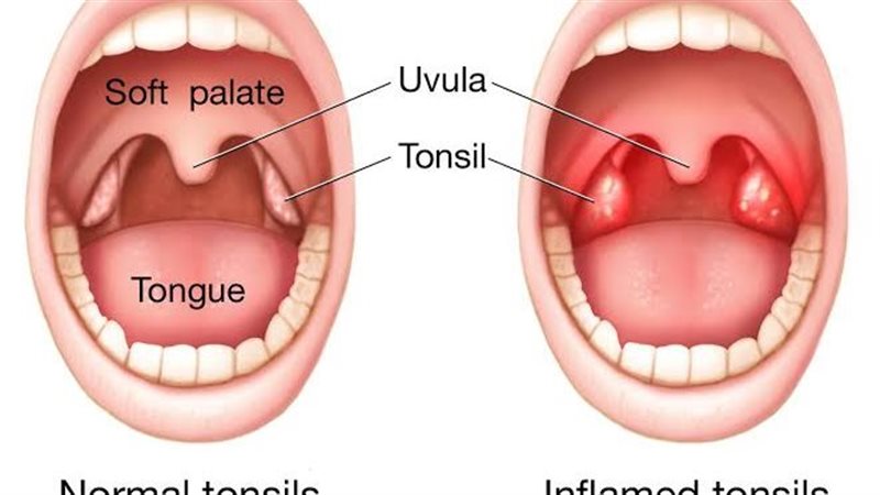 علاج التهاب اللوزتين،
