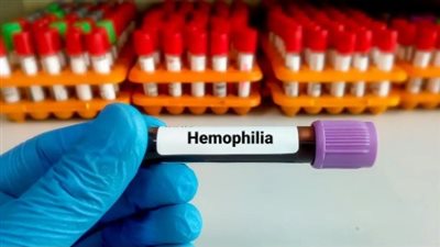  بسبب تعقيد الإجراءات، صحة الشيوخ تقدم مقترحات لرفع معاناة مرضى الهيموفيليا