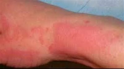 الصحة توضح مدة تجديد خلايا الجلد بعد الحروق