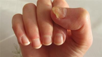 أعراض فقر الدم، وطرق العلاج والوقاية