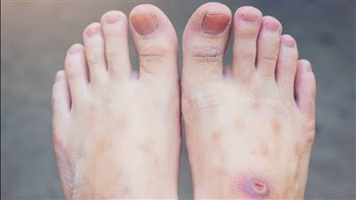 أسباب الإصابة بالغرغرينا وطرق الوقاية منها 