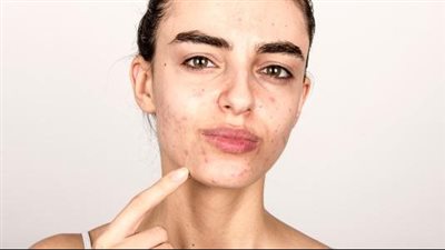  قناع الأسبرين والقهوة لتنظيف البشرة الدهنية ومحاربة حب الشباب