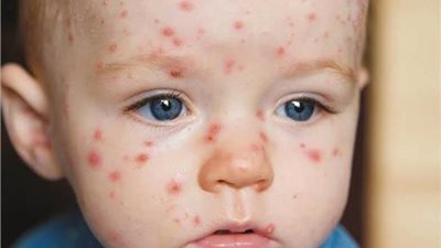 بعد انتشاره بالمدارس، موقف الطلاب المصابين بالجديري المائي من الامتحانات 